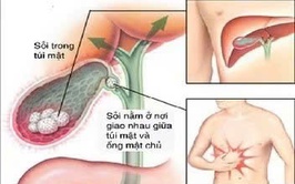 Chủ động theo dõi để phòng ngừa biến chứng sau phẫu thuật sỏi mật