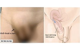 Thoát vị bẹn ở trẻ: 3 dấu hiệu cần đưa trẻ đi khám sớm