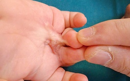 Bỏng nhiệt ở trẻ em và cách xử trí đúng cách