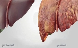 Mới 17 tuổi đã gan nhiễm mỡ, tiền đái tháo đường: Báo động lối sống giới trẻ