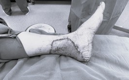 BVĐK Hòe Nhai: Xử trí thành công ca bệnh vết thương lóc da phức tạp vùng cổ gót chân