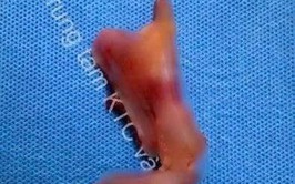 U nhầy ruột thừa: Mối nguy âm thầm không nên xem nhẹ