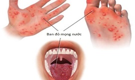 Tăng cường phòng chống bệnh Tay chân miệng