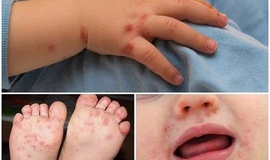 Bệnh tay chân miệng và các biện pháp phòng bệnh 