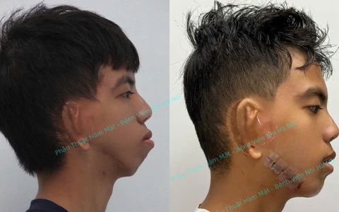 Cơ hội phẫu thuật miễn phí cho trẻ khe hở môi – vòm miệng dưới 16 tuổi tại Bệnh viện Nhi Hà Nội