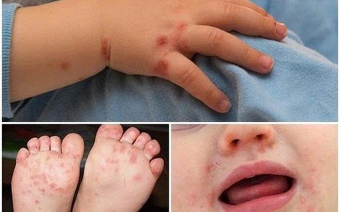 Bệnh tay chân miệng và các biện pháp phòng bệnh 