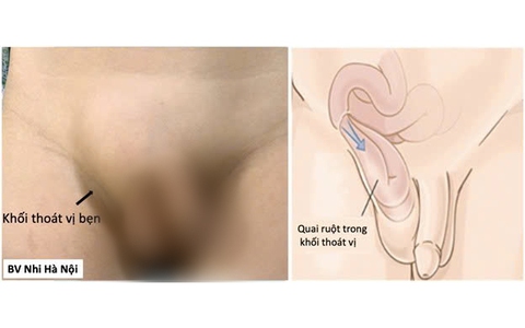 Thoát vị bẹn ở trẻ: 3 dấu hiệu cần đưa trẻ đi khám sớm