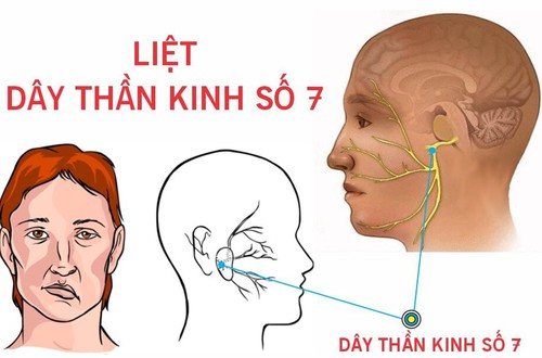 BVĐK Hòe Nhai: Cảnh báo liệt dây thần kinh số VII