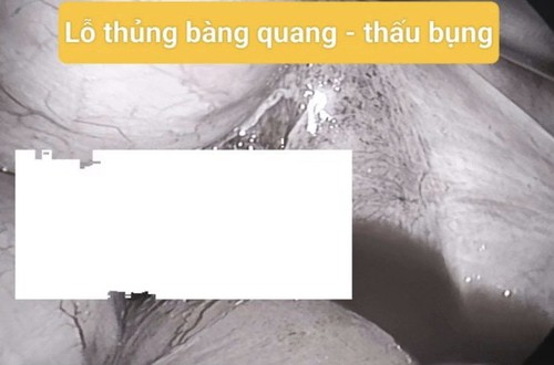 Phẫu thuật cứu sống bệnh nhân bị thanh sắt xuyên thủng trực tràng và bàng quang