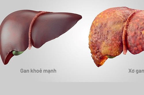 BVĐK Đống Đa cứu sống bệnh nhân mắc xơ gan mất bù nguy kịch