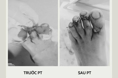 Phẫu thuật cấp cứu ca chấn thương do tai nạn lao động