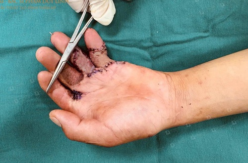 Bệnh viện Đa khoa Đức Giang áp dụng kỹ thuật phẫu thuật tạo hình điều trị sẹo co kéo phức tạp bàn – ngón tay