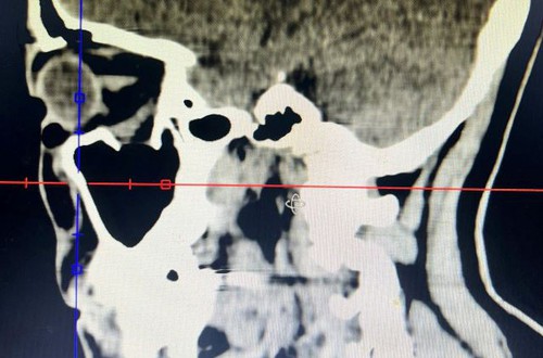 Cấp cứu kịp thời ca chấn thương hàm mặt phức tạp, phục hồi thị lực cho người bệnh