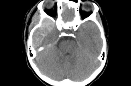 Bệnh viện đa khoa Hà Đông - cuộc đua giành lại sự sống cho bệnh nhân 14 tuổi