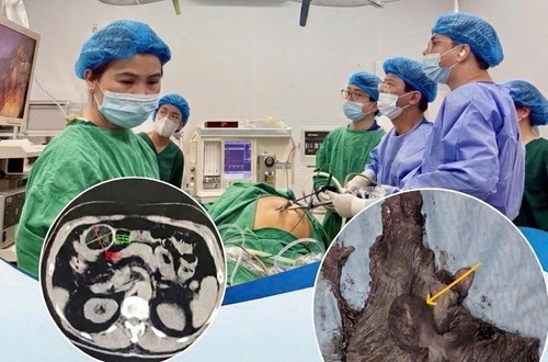 Đừng chủ quan với cơn đau bụng kéo dài: cảnh báo từ ca lâm sàng lồng ruột hiếm gặp