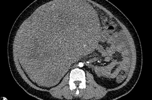 Chủ quan, e ngại không muốn đi khám người phụ nữ mang khối u sarcoma tử cung nặng gần 9kg