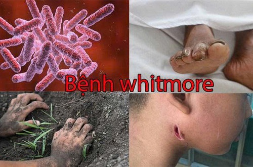 Những điều cần biết về bệnh Whitmore - Hiểu đúng để chủ động phòng bệnh