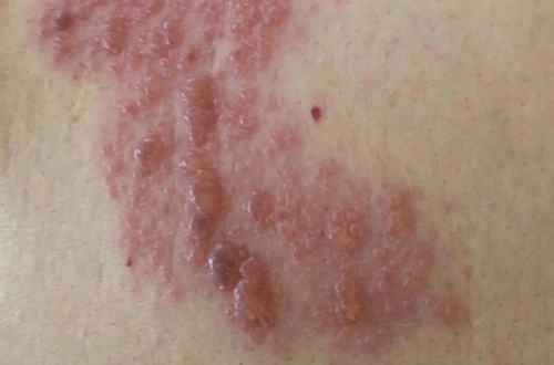 Zona thần kinh- đừng chủ quan với cơn đau âm ỉ kéo dài