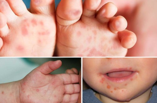 Cách phát hiện sớm trẻ mắc tay chân miệng