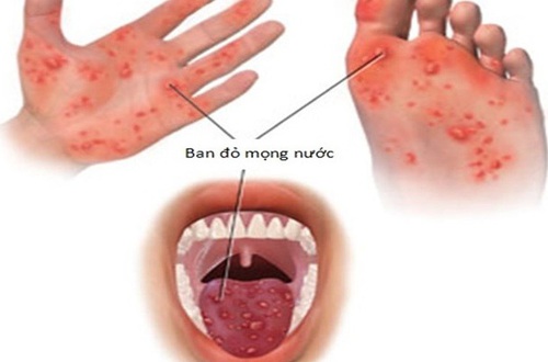 Hướng dẫn theo dõi và chăm sóc trẻ mắc tay chân miệng tại nhà