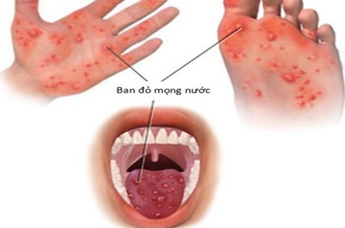 7 sai lầm nguy hiểm và cách phòng tay chân miệng