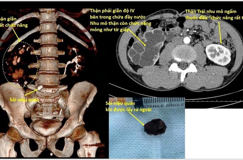 Bệnh viện Thận Hà Nội khuyến cáo không chủ quan với sỏi thận tiết niệu