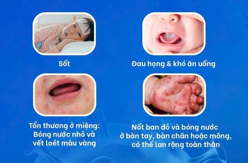 Chủ động nhận biết sớm bệnh tay chân miệng để bảo vệ trẻ nhỏ trước nguy cơ biến chứng nguy hiểm