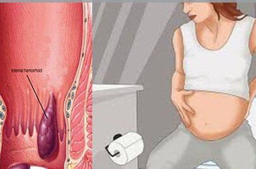 Khuyến cáo điều trị bệnh trĩ cấp ở phụ nữ mang thai và sau sinh: Ưu tiên bảo tồn, hạn chế can thiệp phẫu thuật