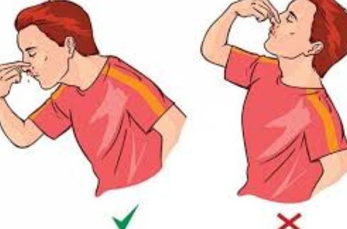 Cần xử trí chảy máu cam đúng cách để tránh biến chứng