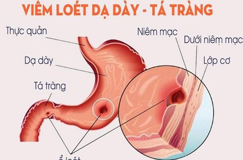 Đừng xem nhẹ viêm loét dạ dày - tá tràng ở trẻ vị thành niên