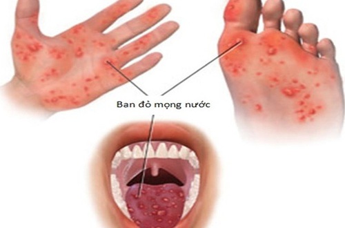 Những điều cần biết về bệnh tay chân miệng: Trẻ mắc nhiều lần có nguy hiểm không?