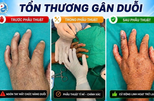 Bệnh viện đa khoa Hòe Nhai: Phẫu thuật phục hồi chức năng duỗi ngón tay thành công cho người bệnh tổn thương gân duỗi