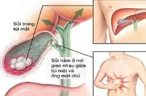 Chủ động theo dõi để phòng ngừa biến chứng sau phẫu thuật sỏi mật