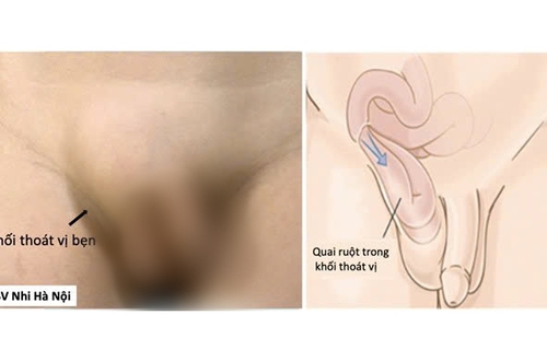 Thoát vị bẹn ở trẻ: 3 dấu hiệu cần đưa trẻ đi khám sớm