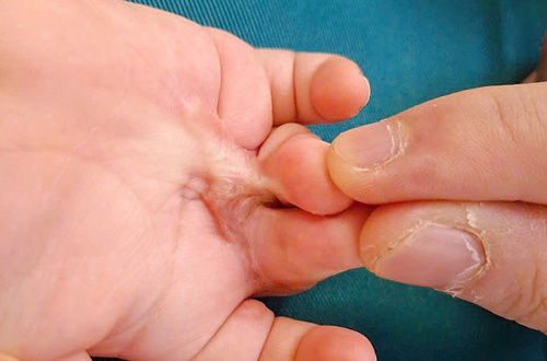 Bỏng nhiệt ở trẻ em và cách xử trí đúng cách