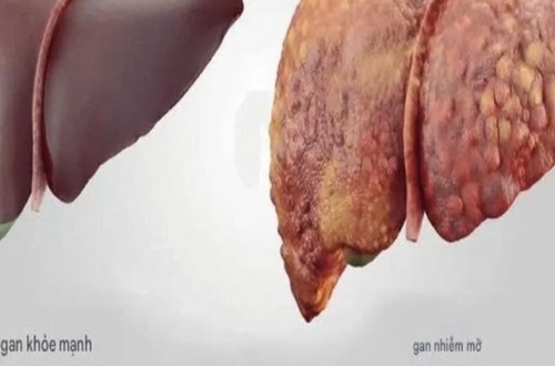 Mới 17 tuổi đã gan nhiễm mỡ, tiền đái tháo đường: Báo động lối sống giới trẻ