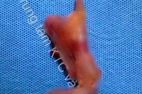 U nhầy ruột thừa: Mối nguy âm thầm không nên xem nhẹ